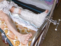 В российской больнице инвалида заставили снимать гипс кусачками - «Здоровье»